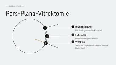 R030 · Beweis — ERKLÄR-DECK: Vitrektomie-Prinzip