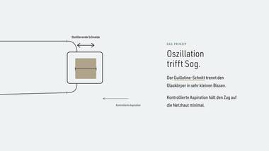 R030 · Vertiefung — ERKLÄR-DECK: Vitrektomie-Prinzip