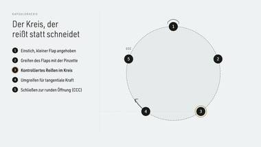 R035 · Beweis — ERKLÄR-DECK: Kapsulorhexis-Schritte